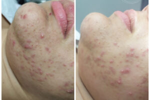 beautyis limpieza de cutis y peeling_03