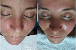 beautyis microneedling dermapen_03 beautyis microneedling dermapen_03