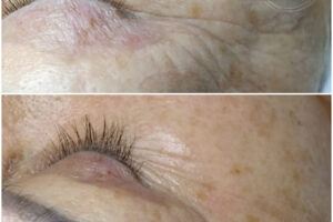 beautyis microneedling dermapen_04 beautyis microneedling dermapen_04