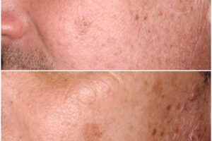 beautyis microneedling dermapen_05 beautyis microneedling dermapen_05