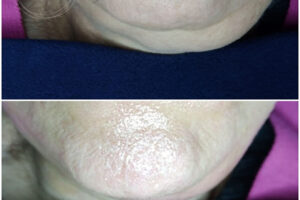 beautyis microneedling dermapen_06 beautyis microneedling dermapen_06