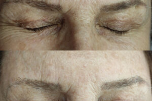 beautyis_borrado laser_02 beautyis_borrado laser_02