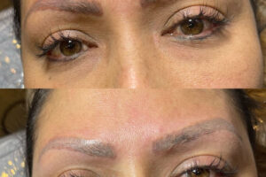 beautyis_borrado laser_03 beautyis_borrado laser_03