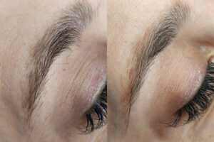 beautyis_borrado laser_04 beautyis_borrado laser_04