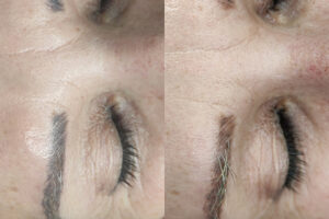 beautyis_borrado laser_05 beautyis_borrado laser_05